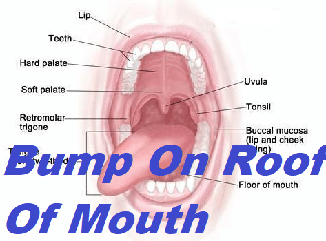 Bump On Roof Of Mouth