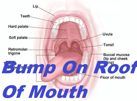 Bump On Roof Of Mouth Grow Health