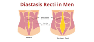 Diastasis Recti In Men | Symptoms | Causes | Exercise