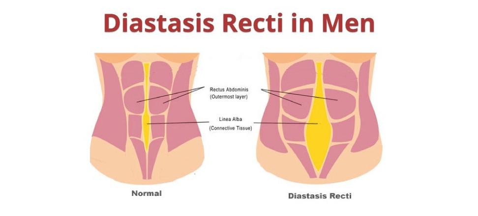 Diastasis Recti In Men
