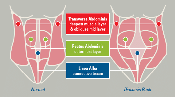 Diastasis Recti comparison