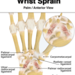 Sprained Wrist Symptoms and Treatments