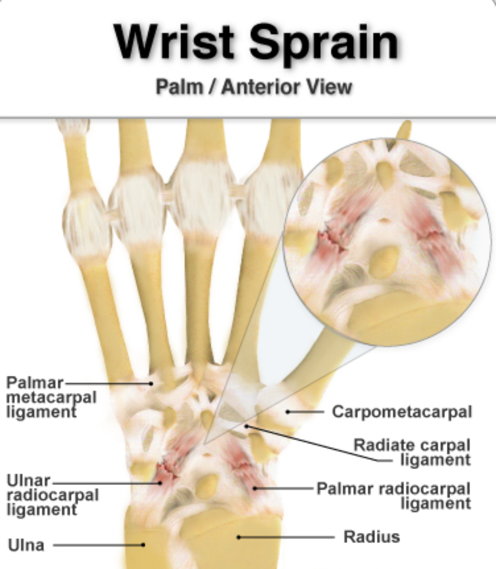 Sprained Wrist Symptoms And Treatments Grow Health 4585