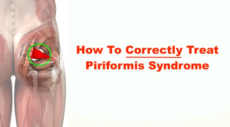 What Is Piriformis Syndrome? Example – Grow Health