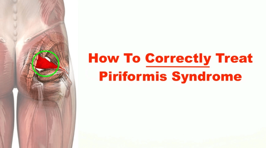 Piriformis Syndrome Treatment 