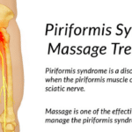 What Is Piriformis Syndrome? Example