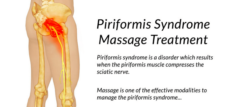 Piriformis syndrome что за болезнь