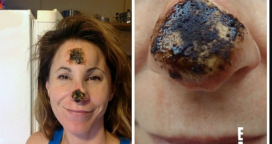 A Review Of Black Salve