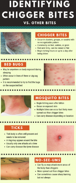 How To Get Rid Of Chigger Bites