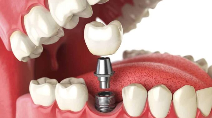 Everything You Need to Know about Dental Implants