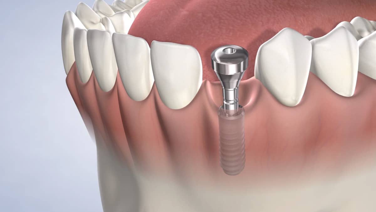bone graft is recommended