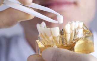 How Dental Implants Can Help Patients After Tragedy